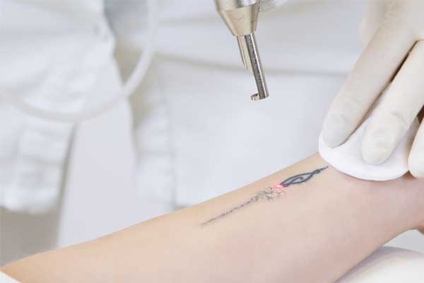 Laser tattoo removal